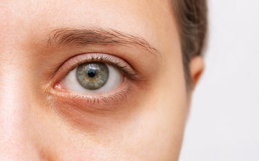 Zbliżenie na twarz kobiety z cieniami pod oczami